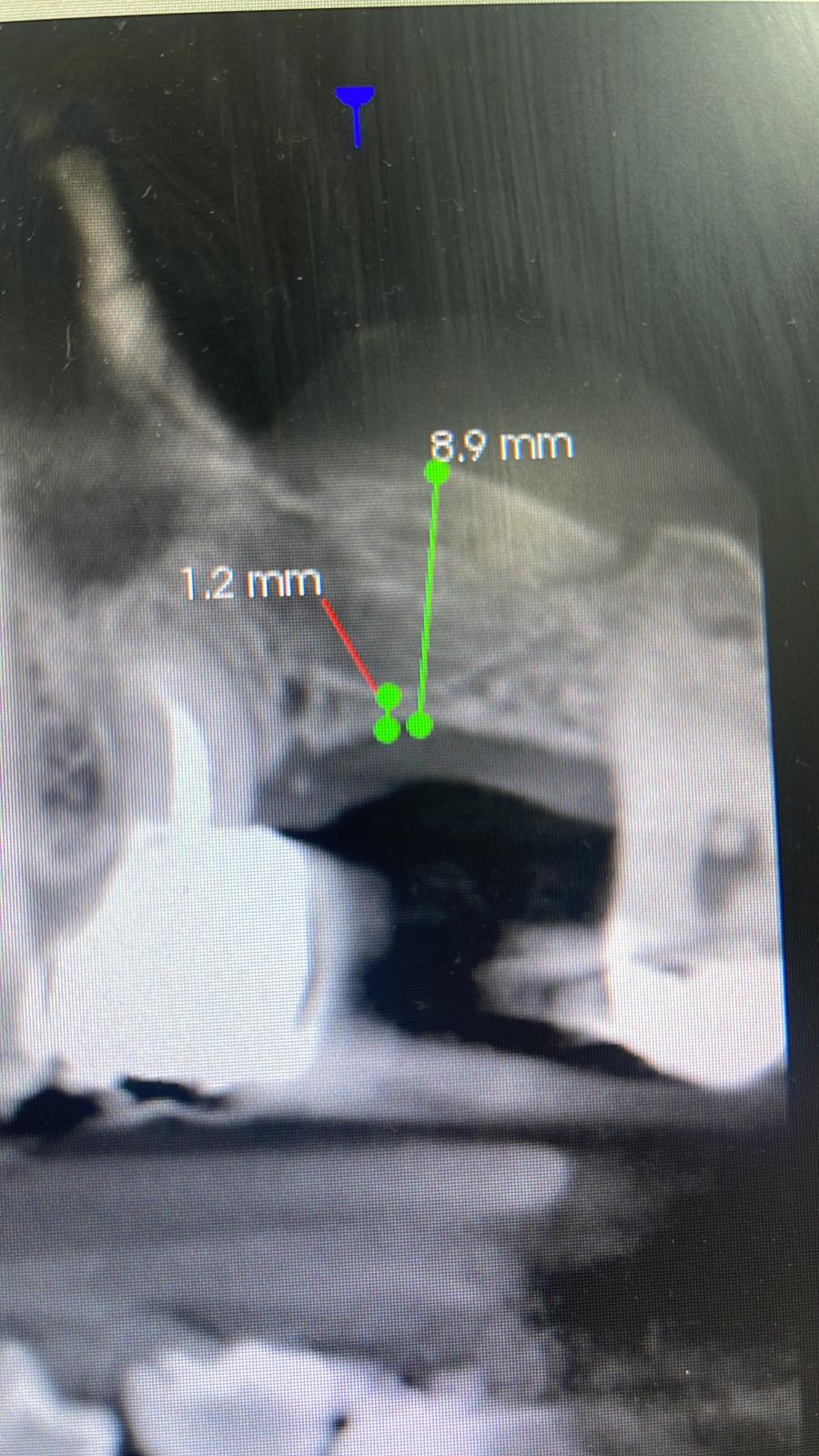 External sinus lift clinical case 1