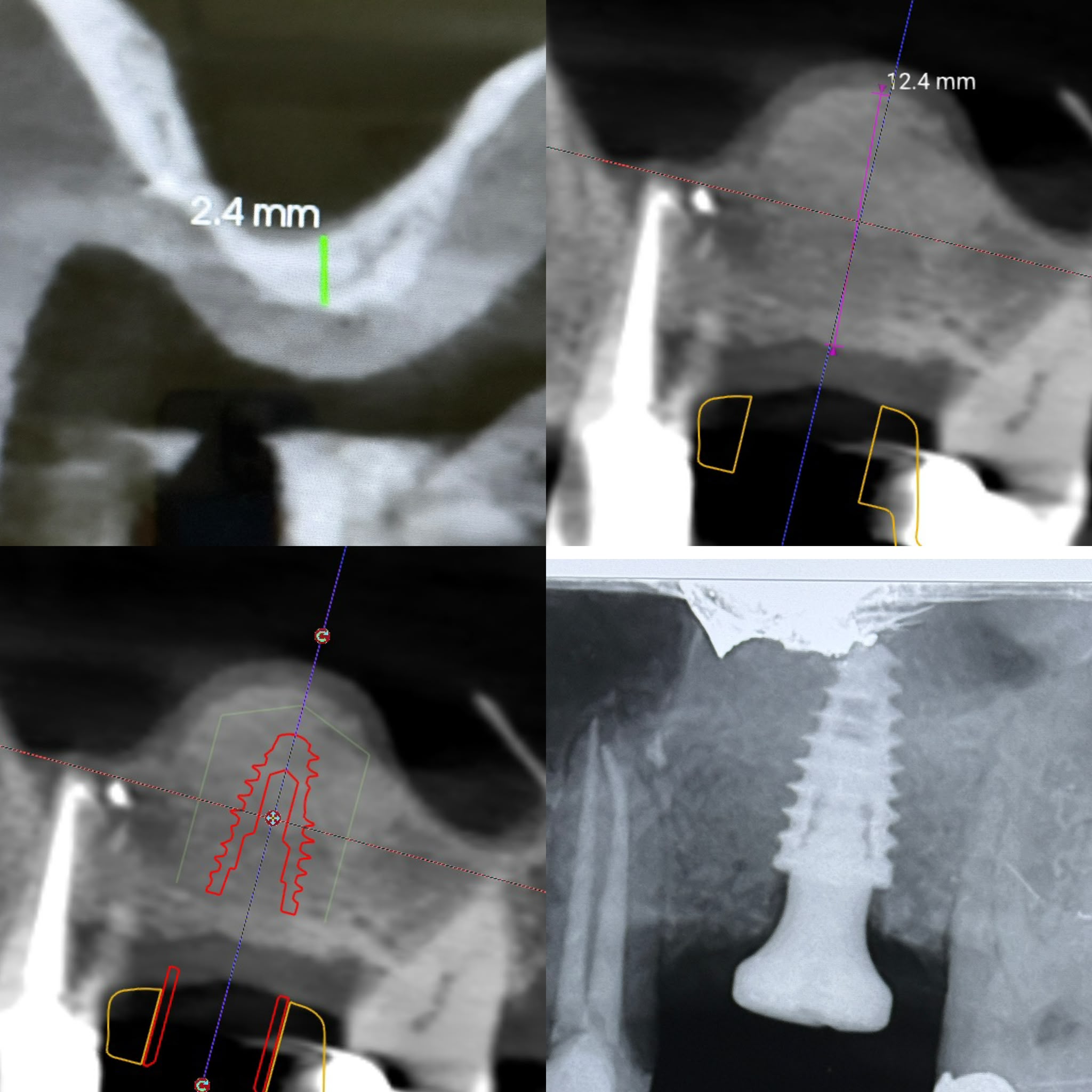 External sinus lift clinical case 2