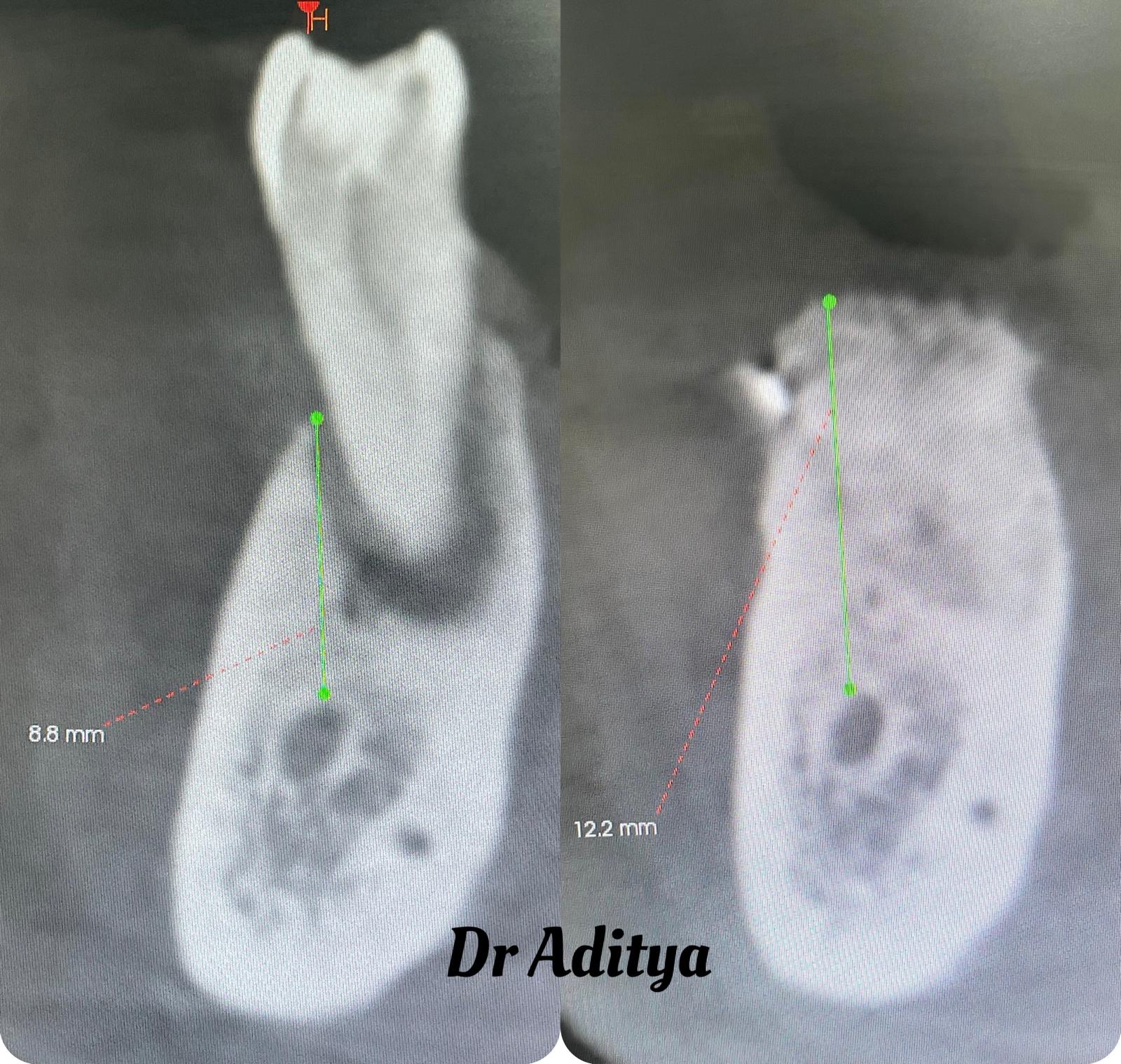 Bone augmentation clinical case 1