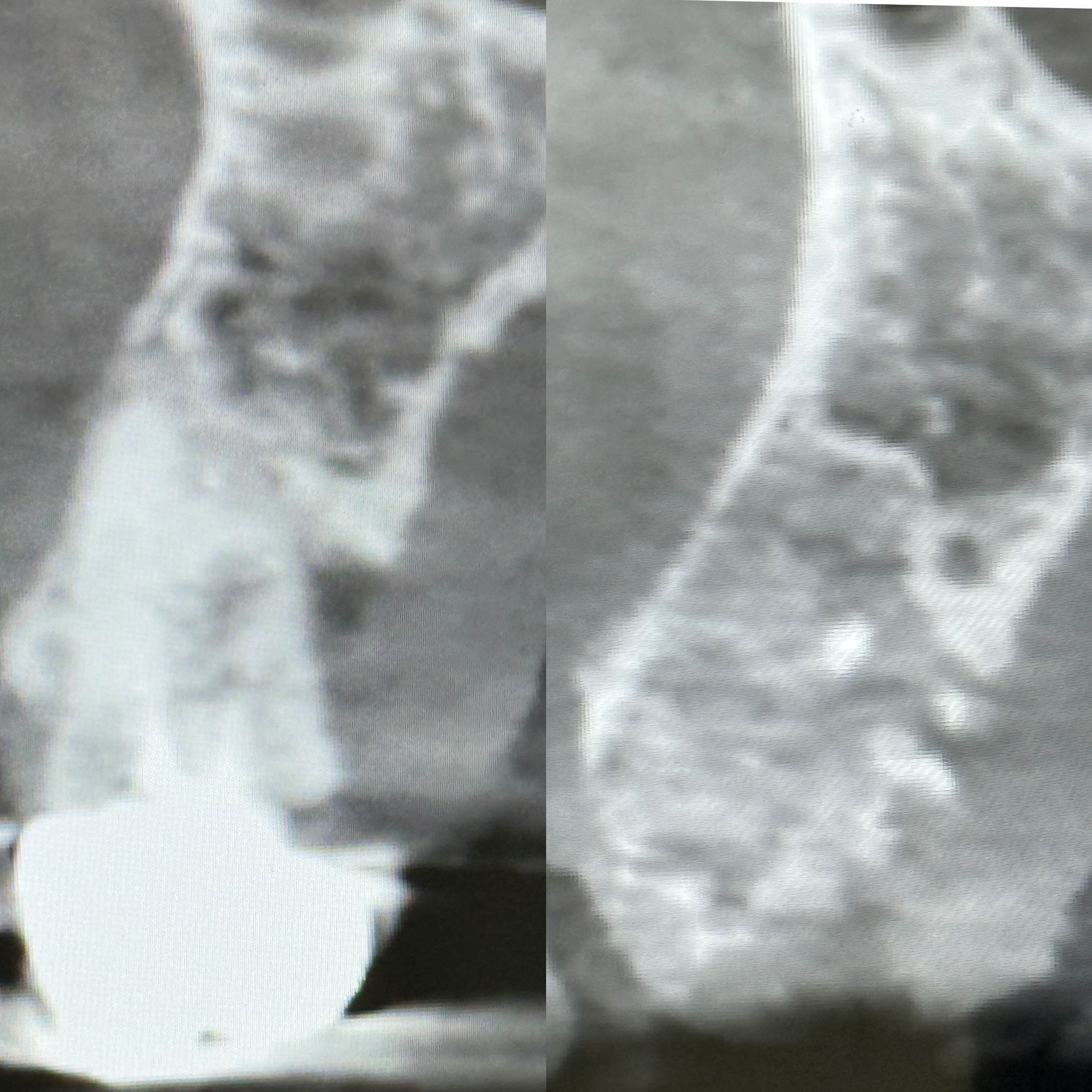 Bone augmentation clinical case 2