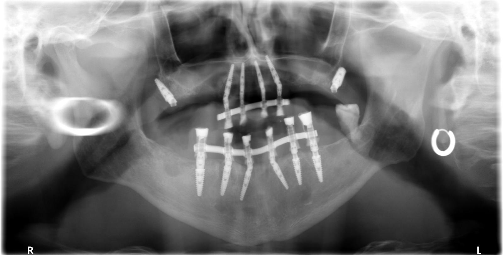 Full-arch implants clinical case 1