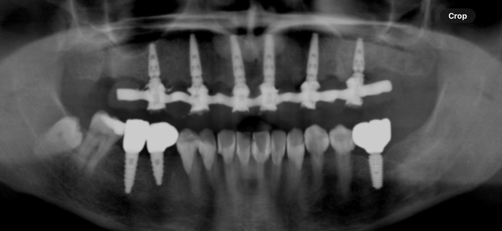 Full-arch implants clinical case 2