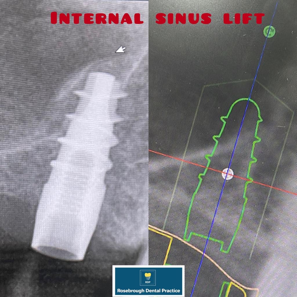 Internal sinus lift clinical case 1